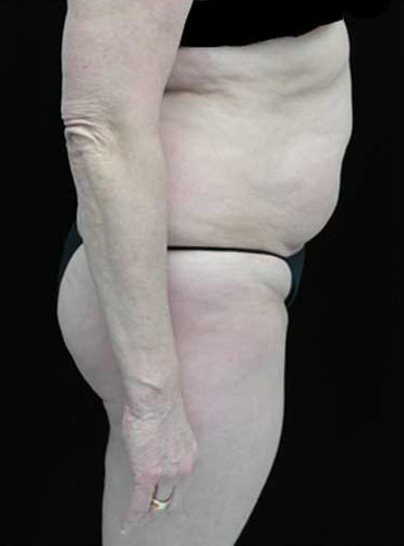 Tummy Tuck Before & After Patient #15085