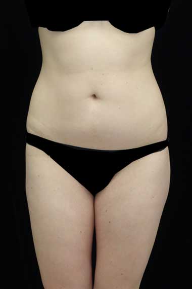 Liposuction Before & After Patient #15052