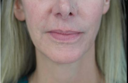 Ultherapy Before & After Patient #14676