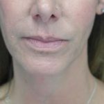 Ultherapy Before & After Patient #14676