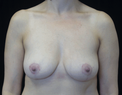 Breast Reduction Before & After Patient #16446