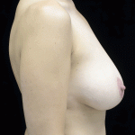 Breast Reduction Before & After Patient #16446