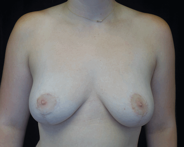 Breast Reduction Before & After Patient #16453