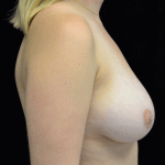 Breast Reduction Before & After Patient #16453