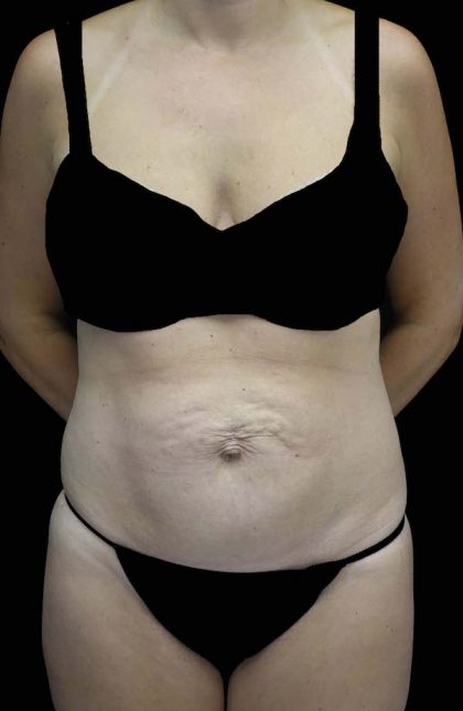 Tummy Tuck Before & After Patient #16587