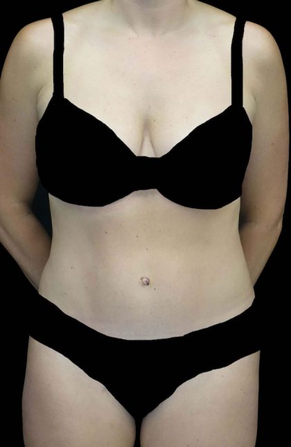 Tummy Tuck Before & After Patient #16587
