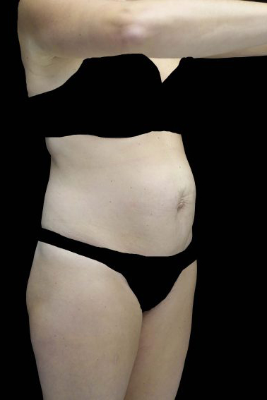 Tummy Tuck Before & After Patient #16587