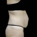 Tummy Tuck Before & After Patient #16587