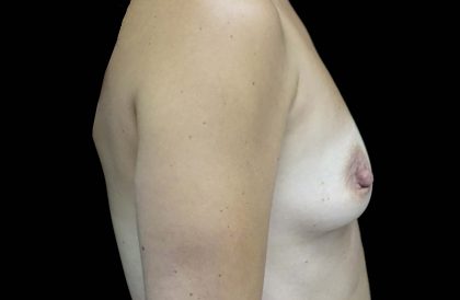 Breast Augmentation (Implants) Before & After Patient #16410