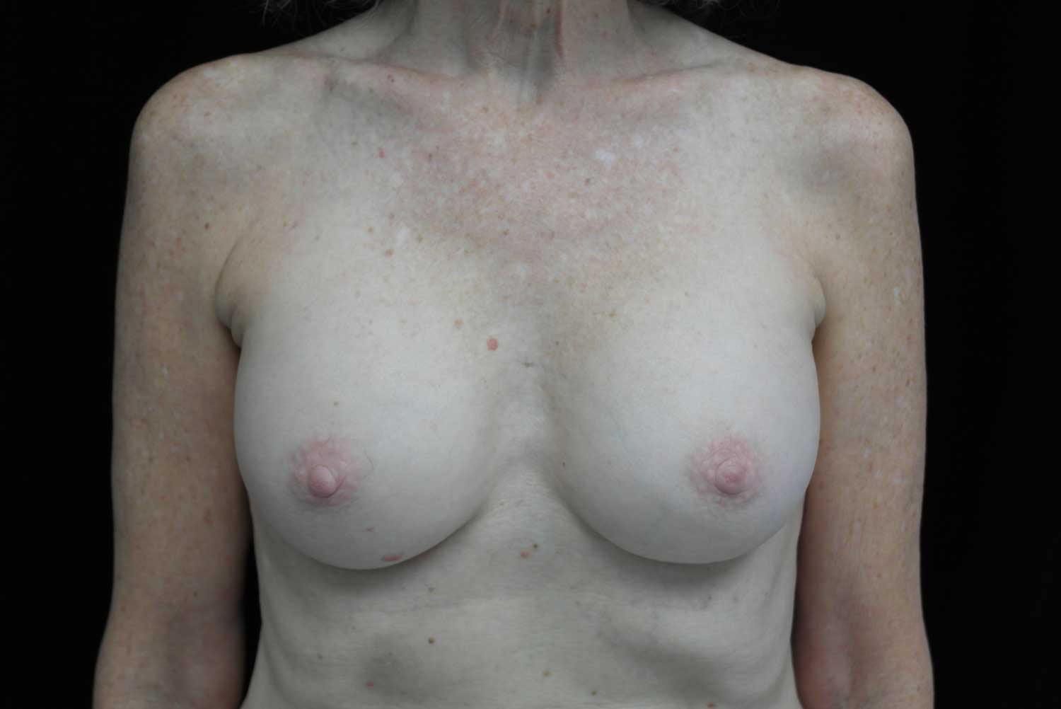 Breast Implant Removal (Explant Surgery) Before & After Patient #16568