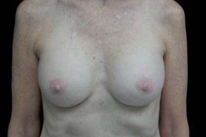 Breast Revision Before & After Patient #16568