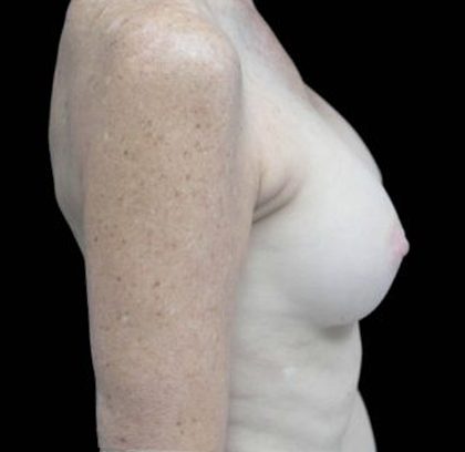 Breast Revision Before & After Patient #16568