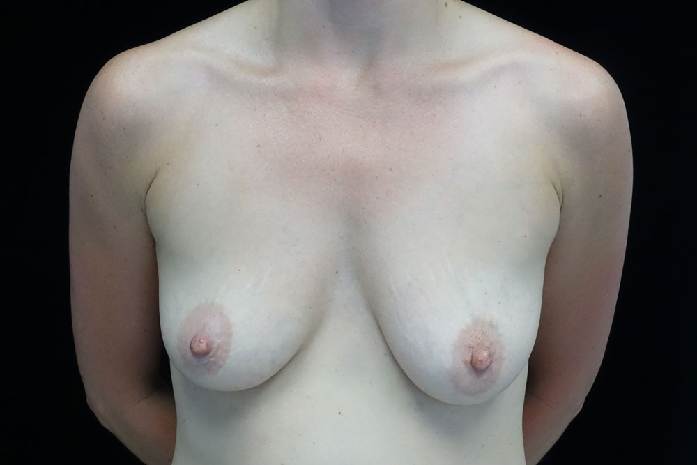 Breast Augmentation (Implants) Before & After Patient #16417