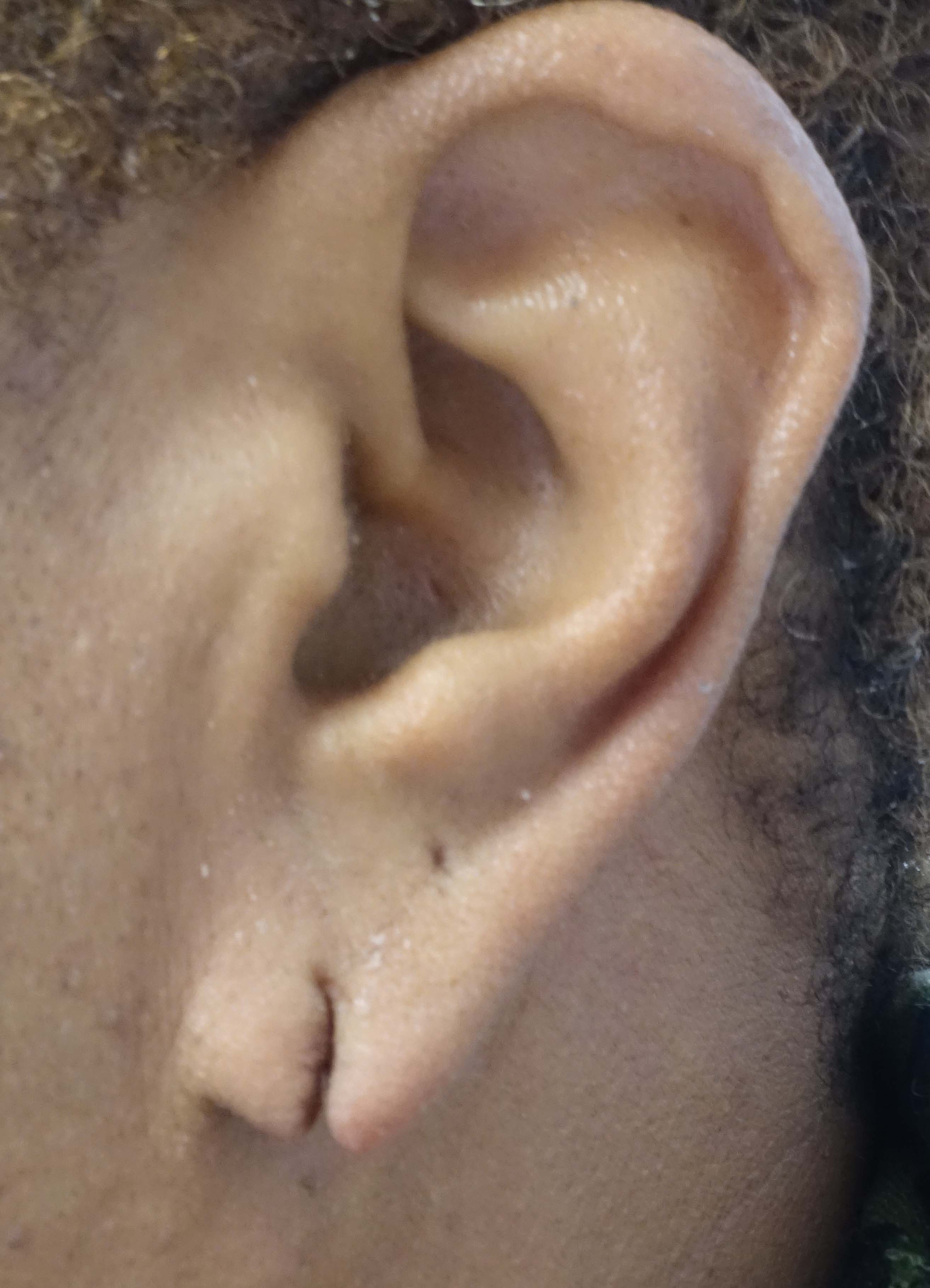 Earlobe Repair Before & After Patient #16473