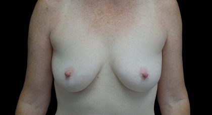 Breast Augmentation (Implants) Before & After Patient #16424