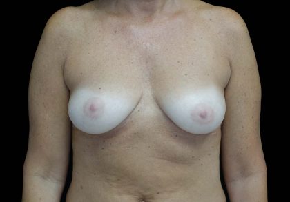 Breast Augmentation (Implants) Before & After Patient #16431