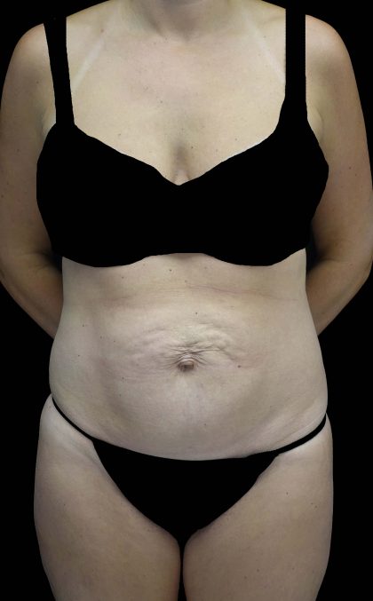 Tummy Tuck Before & After Patient #16587
