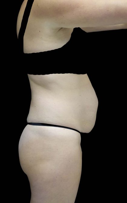 Tummy Tuck Before & After Patient #16587