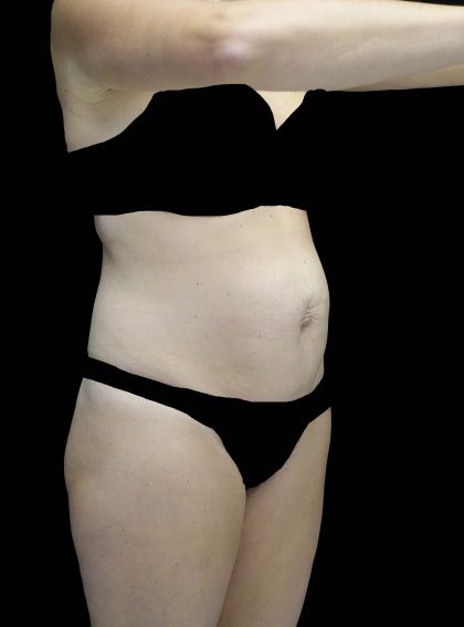 Tummy Tuck Before & After Patient #16587