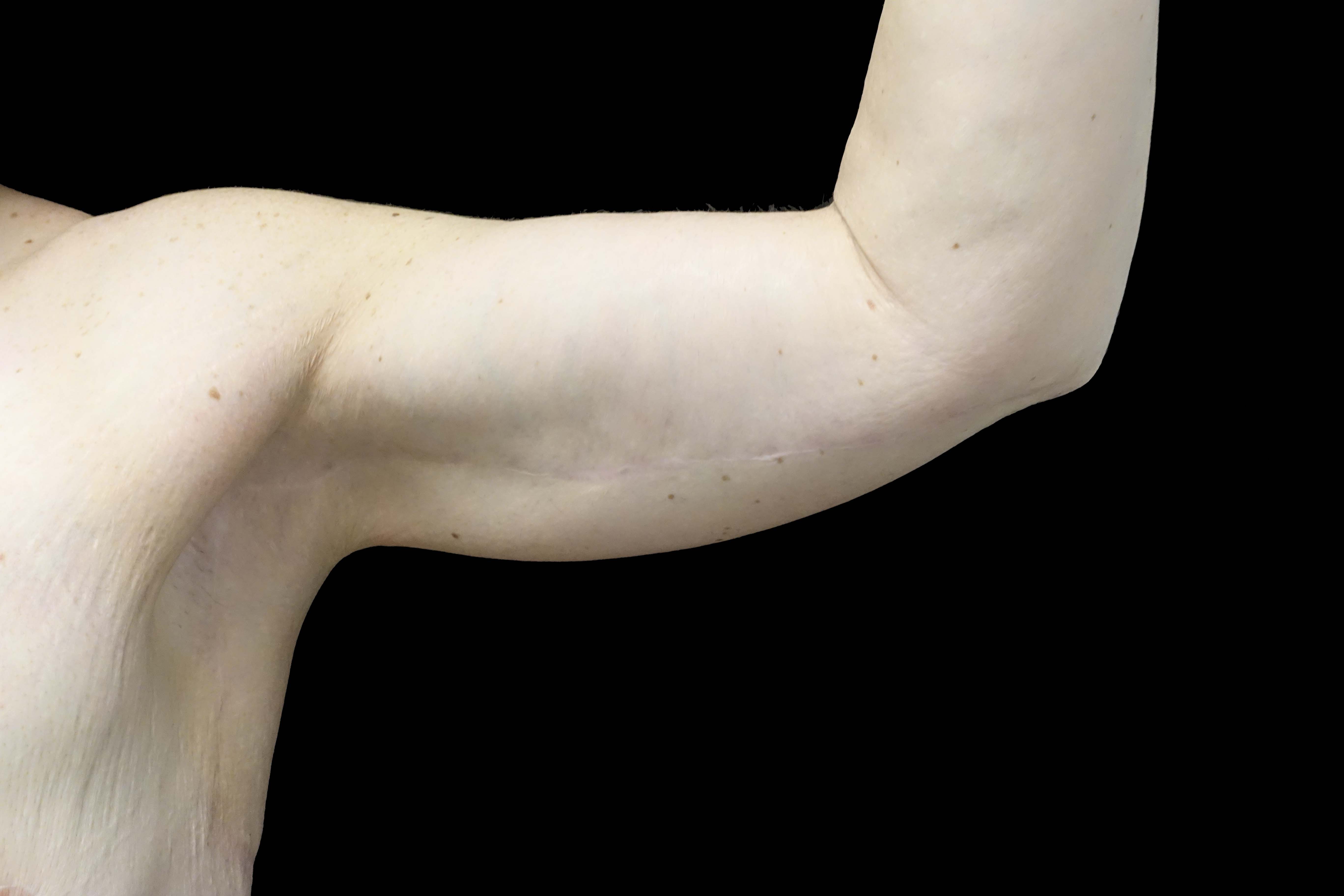 Brachioplasty Before & After Patient #16460