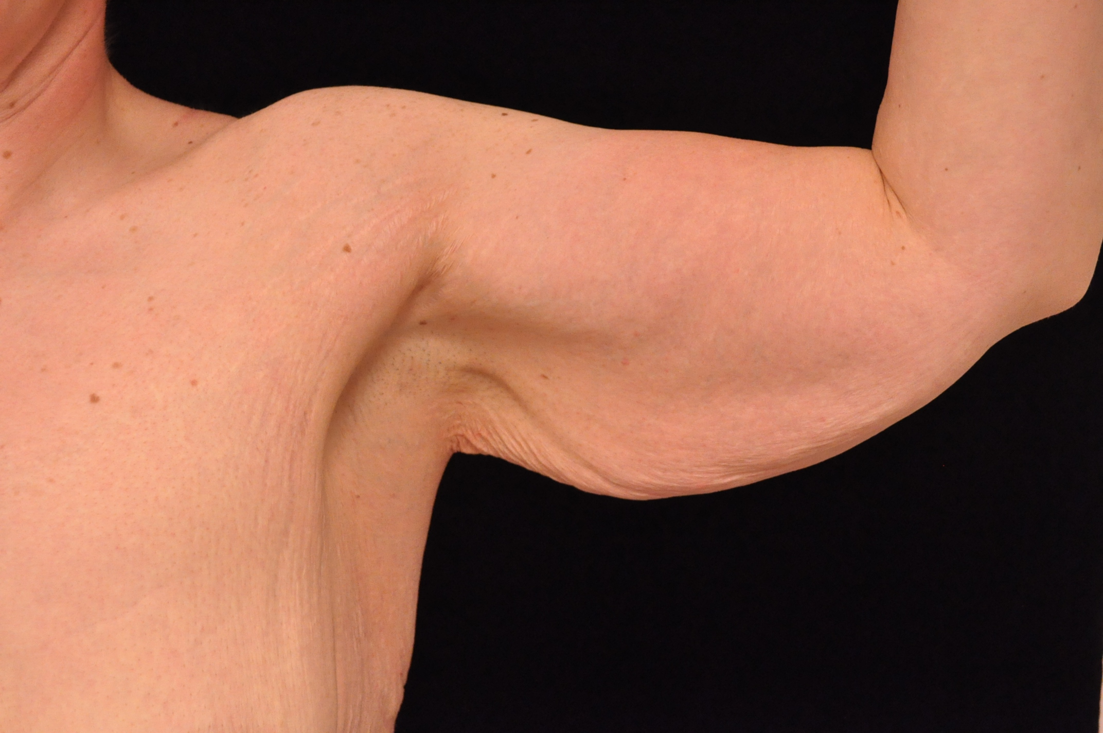 Brachioplasty Before & After Patient #16460