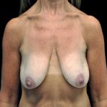 Breast Lift with Implants Before & After Patient #16553