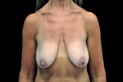 Breast Lift with Implants Before & After Patient #16553