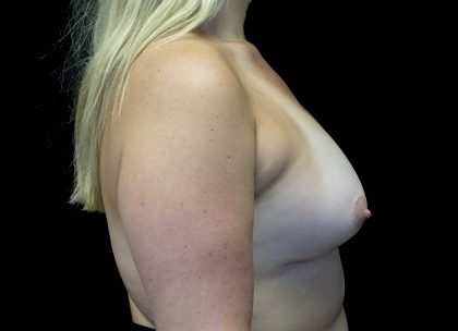 Breast Augmentation (Implants) Before & After Patient #16403