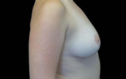 Breast Reduction Before & After Patient #16453