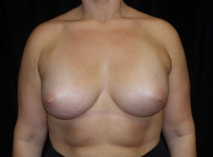Breast Augmentation (Implants) Before & After Patient #16403
