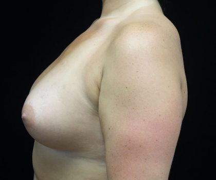 Breast Augmentation (Implants) Before & After Patient #16403