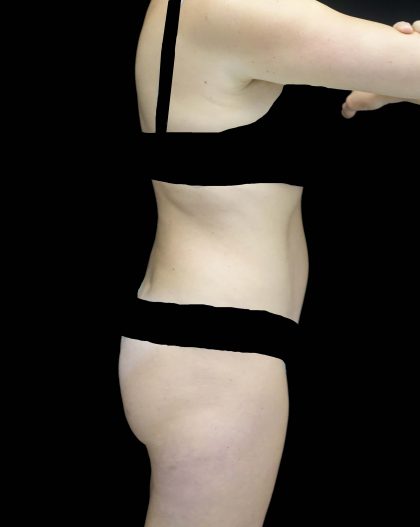Tummy Tuck Before & After Patient #16587