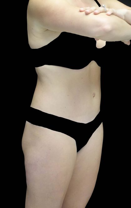 Tummy Tuck Before & After Patient #16587