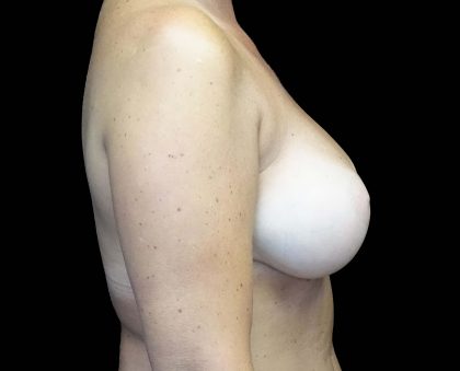 Breast Augmentation (Implants) Before & After Patient #16431