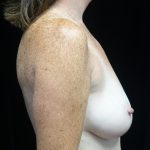 Breast Augmentation (Implants) Before & After Patient #16424