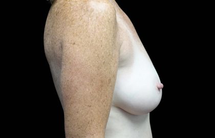 Breast Augmentation (Implants) Before & After Patient #16424