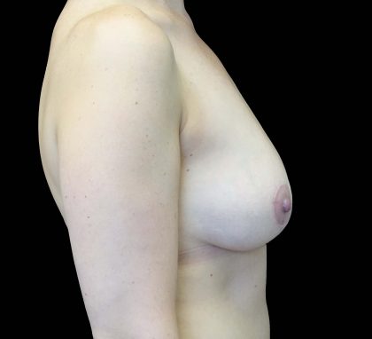 Breast Reduction Before & After Patient #16446