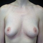 Breast Augmentation (Fat Transfer) Before & After Patient #16476
