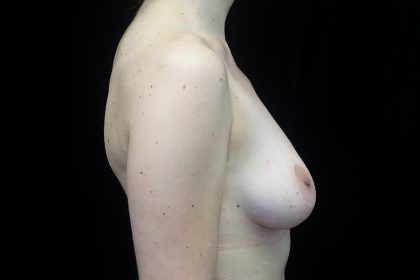 Breast Augmentation (Fat Transfer) Before & After Patient #16476