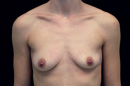 Breast Augmentation (Fat Transfer) Before & After Patient #16490