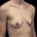 Breast Augmentation (Fat Transfer) Before & After Patient #16490