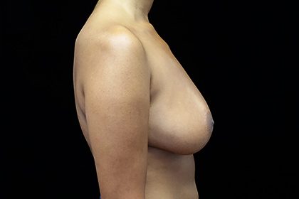 Breast Augmentation (Fat Transfer) Before & After Patient #16497