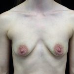 Breast Augmentation (Implants) Before & After Patient #16504