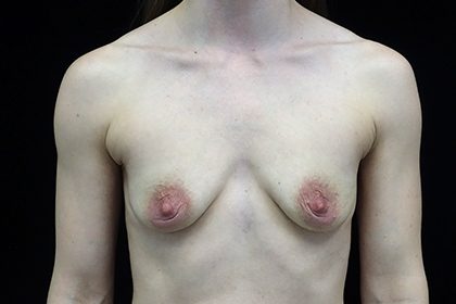 Breast Augmentation (Implants) Before & After Patient #16504