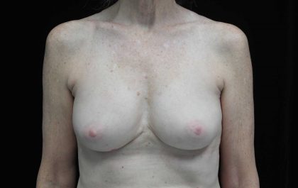 Breast Implant Removal (Explant Surgery) Before & After Patient #16568
