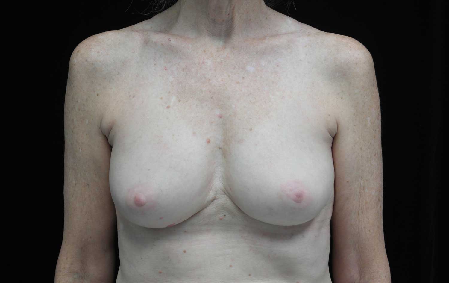 Breast Implant Removal (Explant Surgery) Before & After Patient #16568