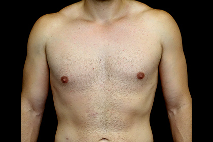 Gynecomastia Before & After Patient #16511