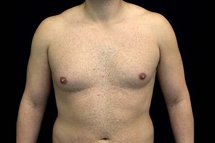 Gynecomastia Before & After Patient #16511