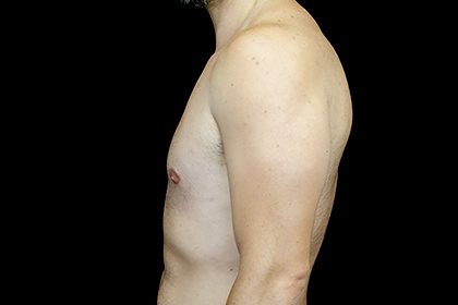 Gynecomastia Before & After Patient #16511