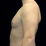 Gynecomastia Before & After Patient #16511